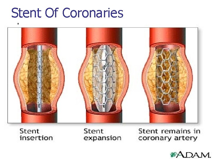 Stent Of Coronaries 