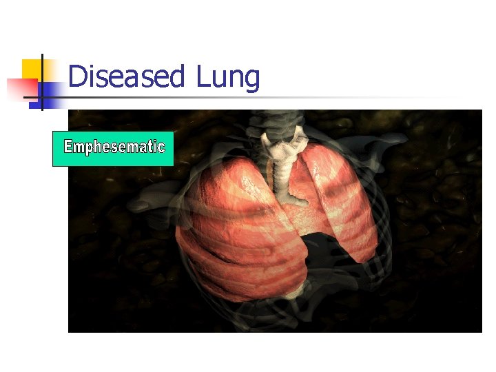 Diseased Lung 