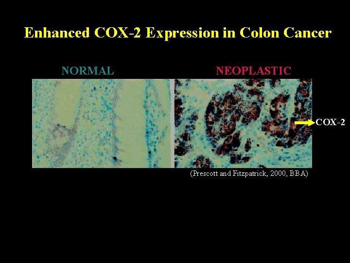 Enhanced COX-2 Expression in Colon Cancer NORMAL NEOPLASTIC COX-2 (Prescott and Fitzpatrick, 2000, BBA)