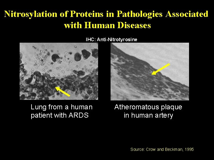 Nitrosylation of Proteins in Pathologies Associated with Human Diseases IHC: Anti-Nitrotyrosine Lung from a