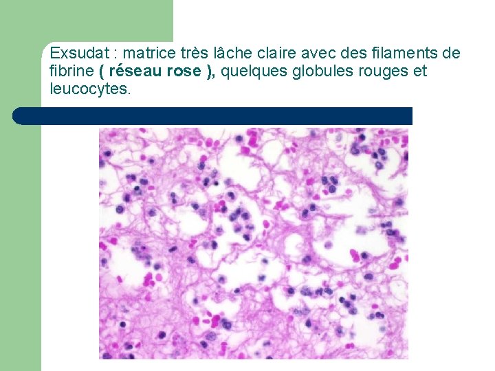 Exsudat : matrice très lâche claire avec des filaments de fibrine ( réseau rose