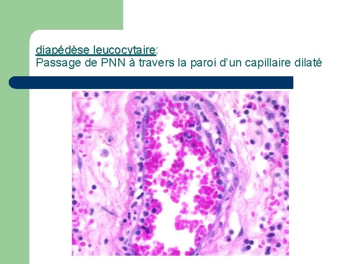 diapédèse leucocytaire: diapédèse leucocytaire Passage de PNN à travers la paroi d’un capillaire dilaté