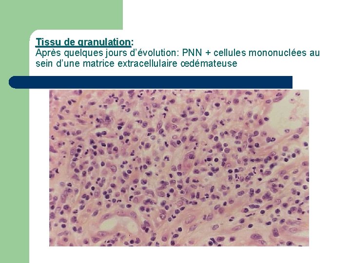 Tissu de granulation: granulation Après quelques jours d’évolution: PNN + cellules mononuclées au sein