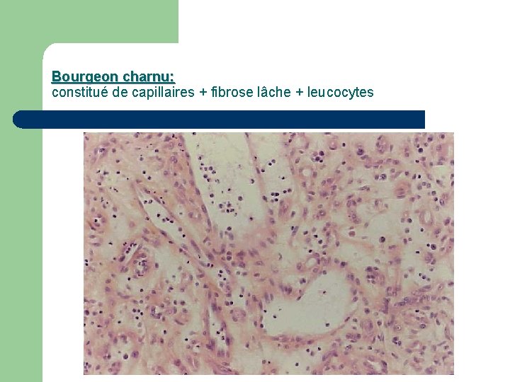 Bourgeon charnu: constitué de capillaires + fibrose lâche + leucocytes 