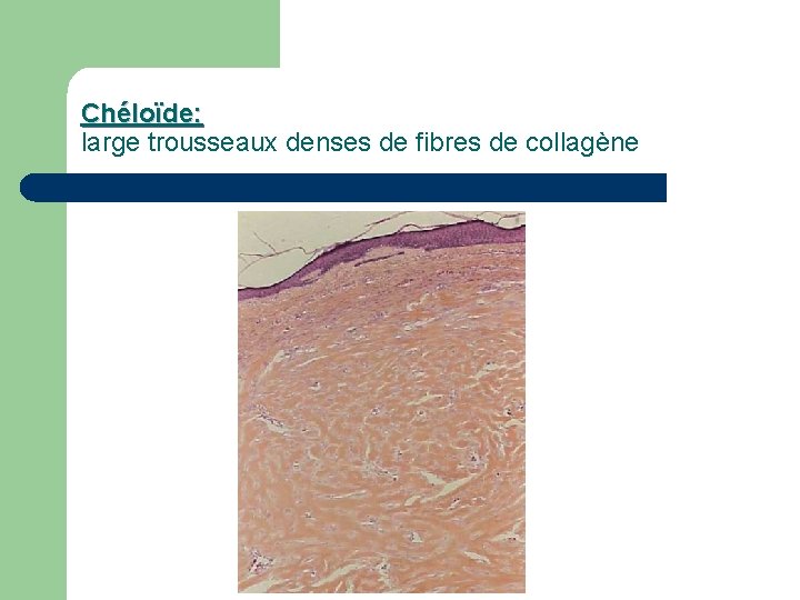 Chéloïde: large trousseaux denses de fibres de collagène 