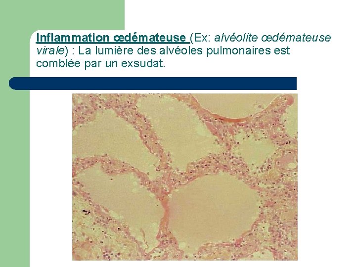 Inflammation œdémateuse (Ex: alvéolite œdémateuse virale) : La lumière des alvéoles pulmonaires est comblée