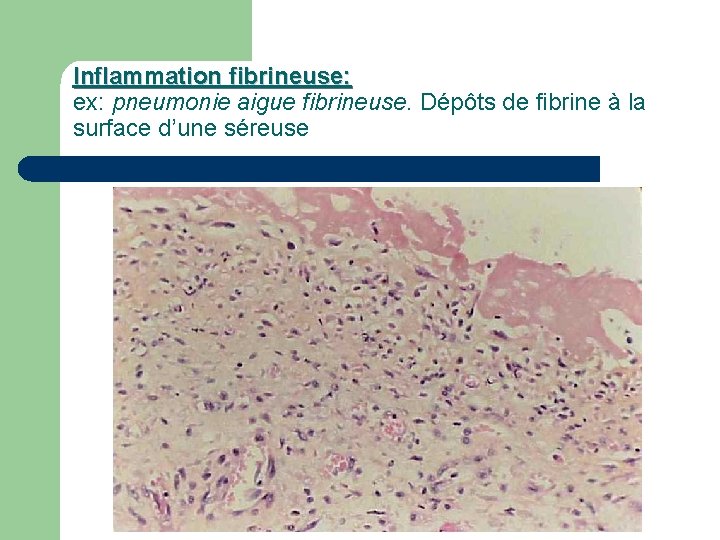 Inflammation fibrineuse: ex: pneumonie aigue fibrineuse. Dépôts de fibrine à la surface d’une séreuse