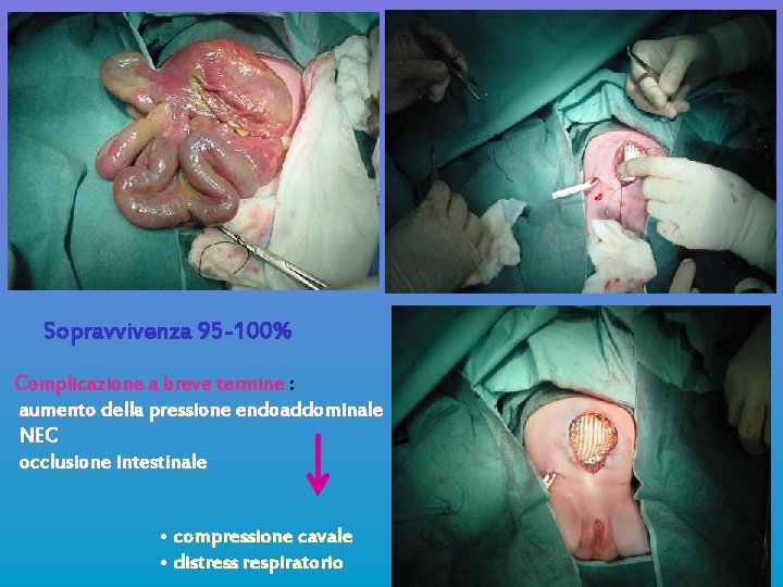 Sopravvivenza 95 -100% Complicazione a breve termine : aumento della pressione endoaddominale NEC occlusione