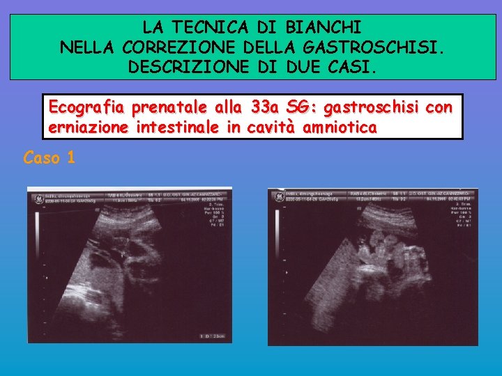 LA TECNICA DI BIANCHI NELLA CORREZIONE DELLA GASTROSCHISI. DESCRIZIONE DI DUE CASI. Ecografia prenatale