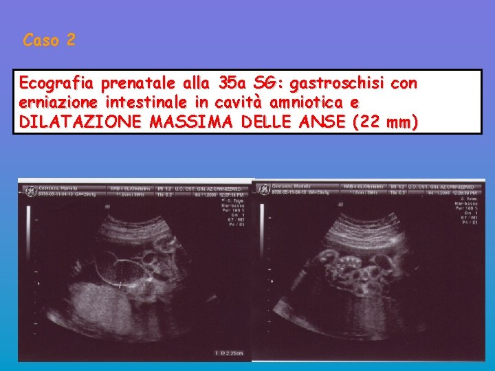 Caso 2 Ecografia prenatale alla 35 a SG: gastroschisi con erniazione intestinale in cavità