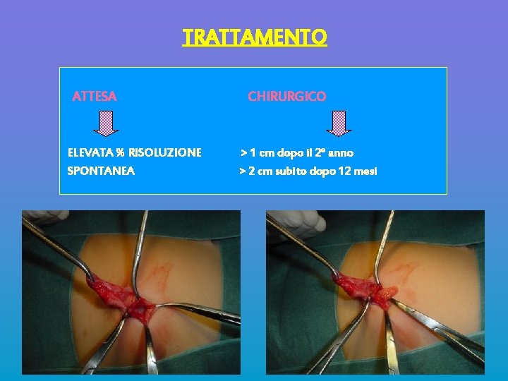 TRATTAMENTO ATTESA ELEVATA % RISOLUZIONE SPONTANEA CHIRURGICO > 1 cm dopo il 2° anno