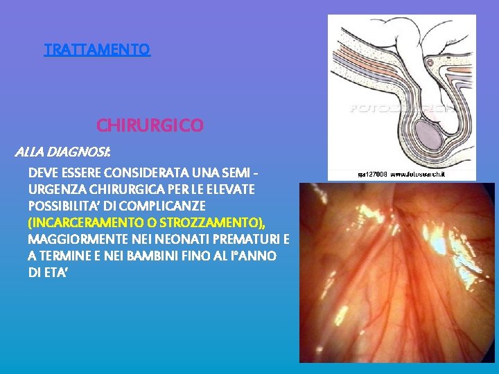 TRATTAMENTO CHIRURGICO ALLA DIAGNOSI: DEVE ESSERE CONSIDERATA UNA SEMI URGENZA CHIRURGICA PER LE ELEVATE