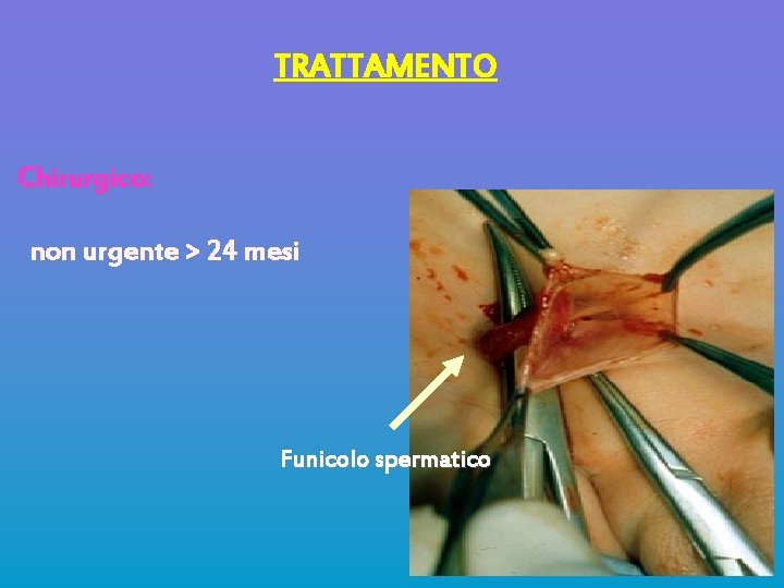 TRATTAMENTO Chirurgico: non urgente > 24 mesi Funicolo spermatico 