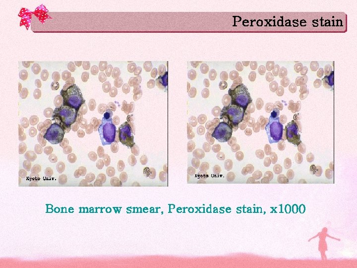 Peroxidase stain Bone marrow smear, Peroxidase stain, x 1000 Peroxidase stain Bone marrow smear, Peroxidase stain, x 1000
