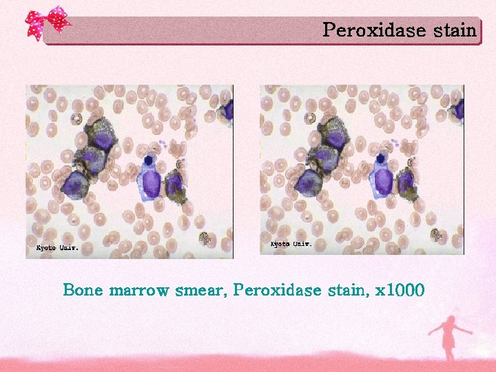 Peroxidase stain Bone marrow smear, Peroxidase stain, x 1000 