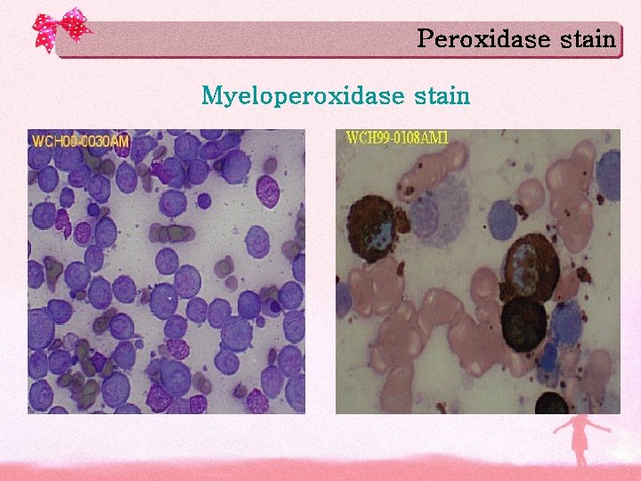 Peroxidase stain Myeloperoxidase stain 