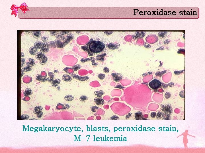 Peroxidase stain Megakaryocyte, blasts, peroxidase stain, M-7 leukemia Peroxidase stain Megakaryocyte, blasts, peroxidase stain, M-7 leukemia