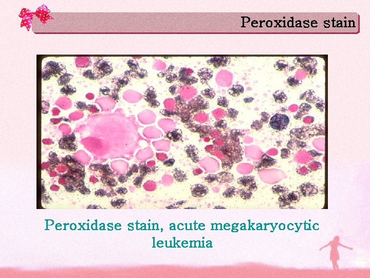 Peroxidase stain, acute megakaryocytic leukemia Peroxidase stain, acute megakaryocytic leukemia