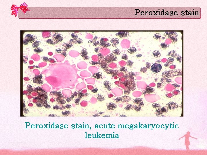 Peroxidase stain, acute megakaryocytic leukemia 