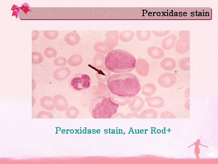 Peroxidase stain, Auer Rod+ Peroxidase stain, Auer Rod+