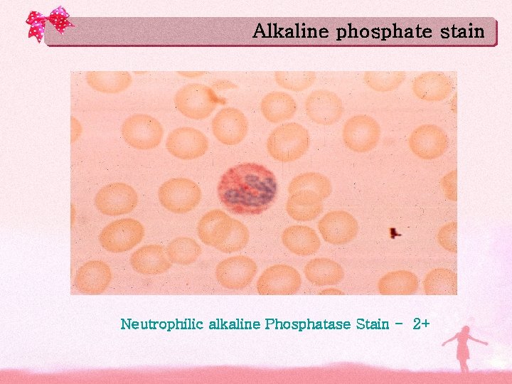 Alkaline phosphate stain Neutrophilic alkaline Phosphatase Stain - 2+ 