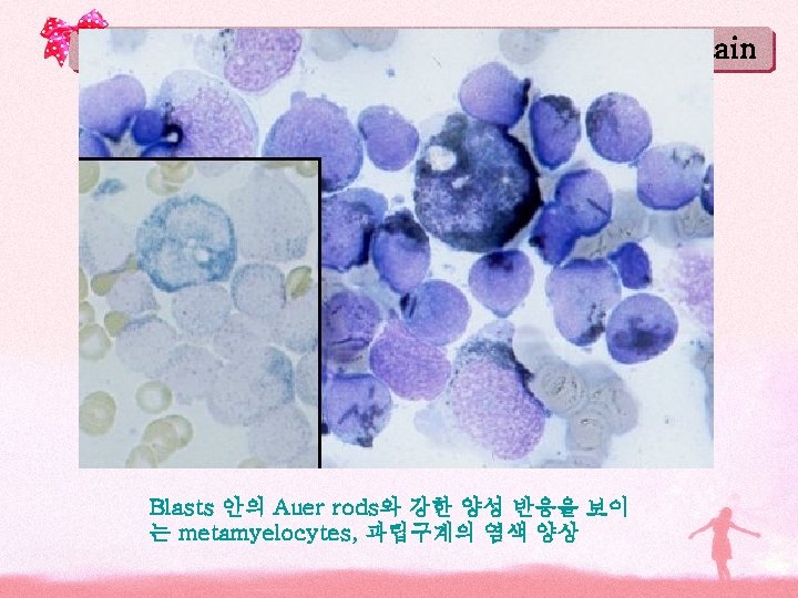 Sudan Black B stain Blasts 안의 Auer rods와 강한 양성 반응을 보이 는 metamyelocytes, Sudan Black B stain Blasts 안의 Auer rods와 강한 양성 반응을 보이 는 metamyelocytes,