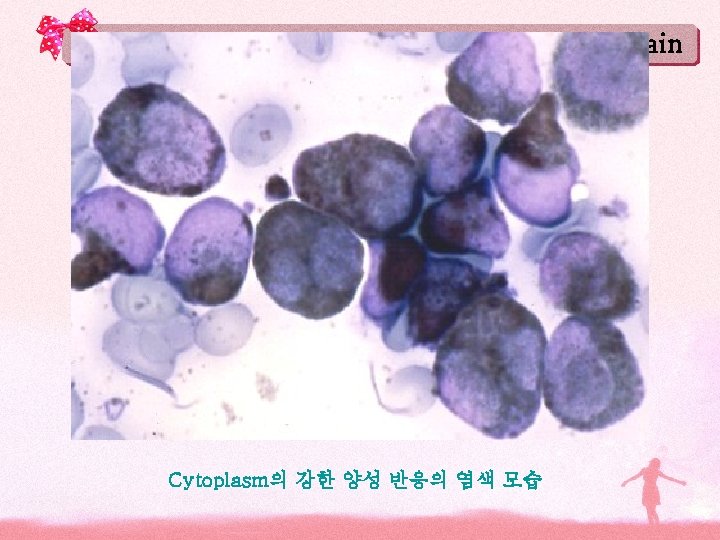 Sudan Black B stain Cytoplasm의 강한 양성 반응의 염색 모습 