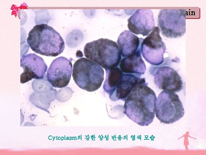 Sudan Black B stain Cytoplasm의 강한 양성 반응의 염색 모습 Sudan Black B stain Cytoplasm의 강한 양성 반응의 염색 모습