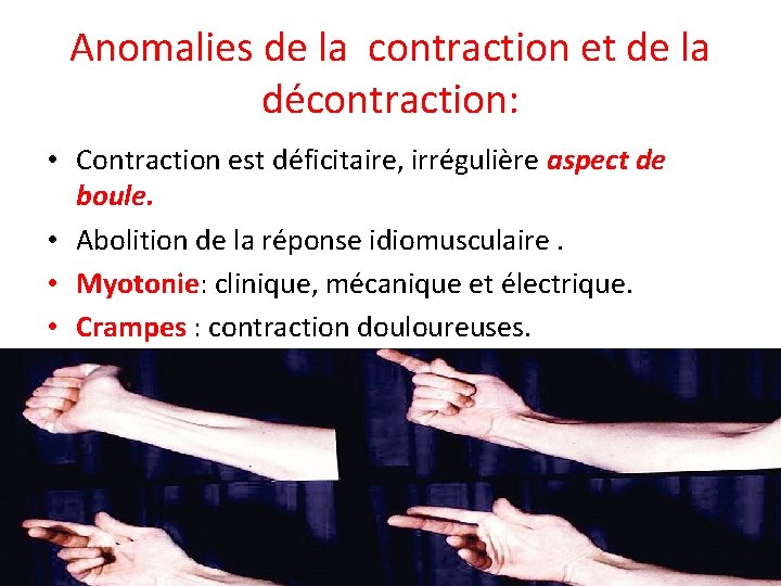 Anomalies de la contraction et de la décontraction: • Contraction est déficitaire, irrégulière aspect