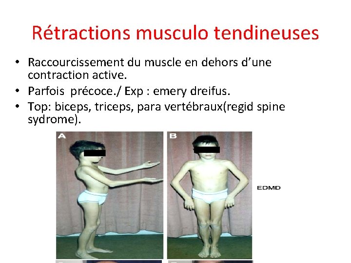 Rétractions musculo tendineuses • Raccourcissement du muscle en dehors d’une contraction active. • Parfois