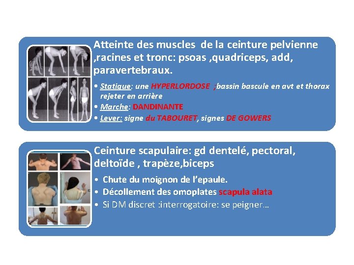 Atteinte des muscles de la ceinture pelvienne , racines et tronc: psoas , quadriceps,