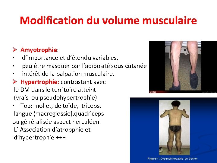 Modification du volume musculaire Ø Amyotrophie: • d’importance et d’étendu variables, • peu être