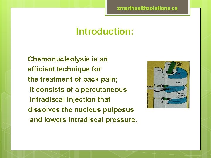 smarthealthsolutions. ca Introduction: Chemonucleolysis is an efficient technique for the treatment of back pain;