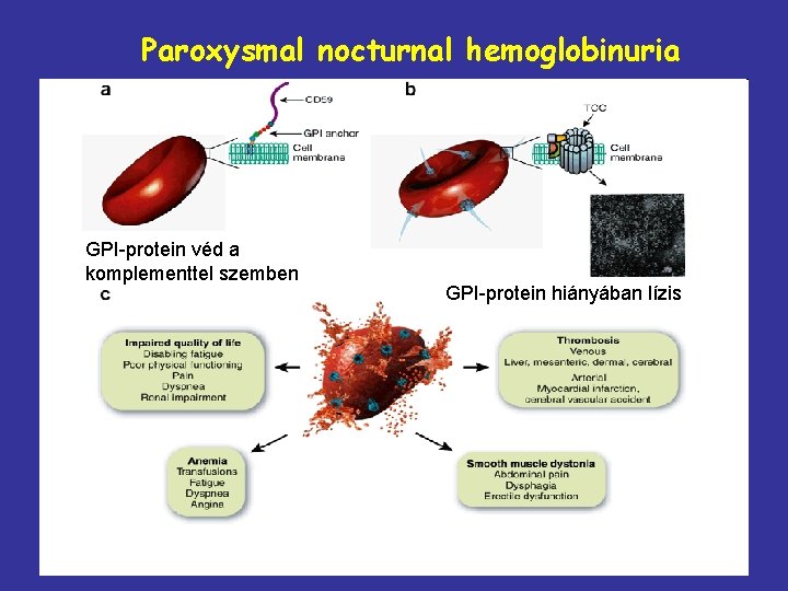 Paroxysmal nocturnal hemoglobinuria GPI-protein véd a komplementtel szemben GPI-protein hiányában lízis 