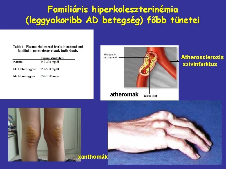 Familiáris hiperkoleszterinémia (leggyakoribb AD betegség) főbb tünetei Atherosclerosis szívinfarktus atheromák xanthomák 