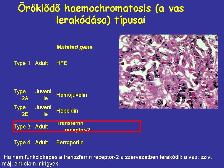 Öröklődő haemochromatosis (a vas lerakódása) típusai Mutated gene Type 1 Adult HFE Type 2