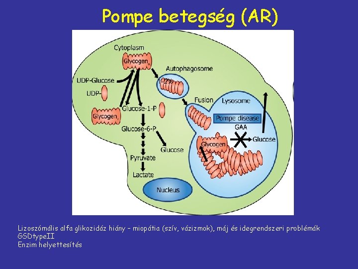 Pompe betegség (AR) 1 -2% Lizoszómális alfa glikozidáz hiány – miopátia (szív, vázizmok), máj