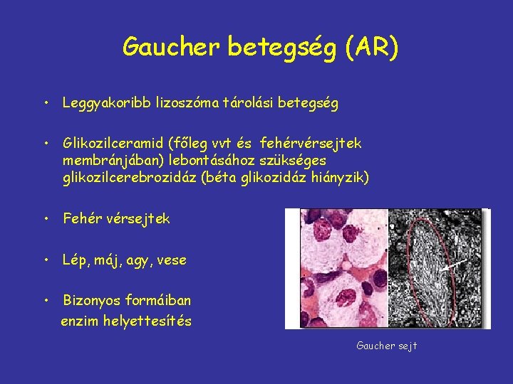 Gaucher betegség (AR) • Leggyakoribb lizoszóma tárolási betegség • Glikozilceramid (főleg vvt és fehérvérsejtek