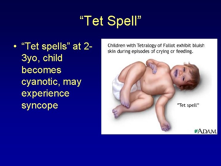 “Tet Spell” • “Tet spells” at 23 yo, child becomes cyanotic, may experience syncope