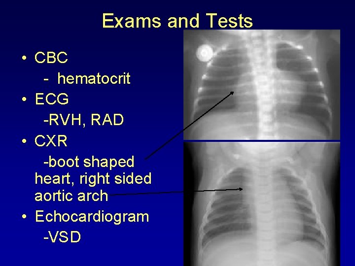 Exams and Tests • CBC - hematocrit • ECG -RVH, RAD • CXR -boot