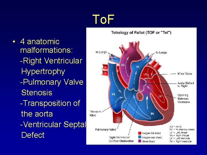 To. F • 4 anatomic malformations: -Right Ventricular Hypertrophy -Pulmonary Valve Stenosis -Transposition of