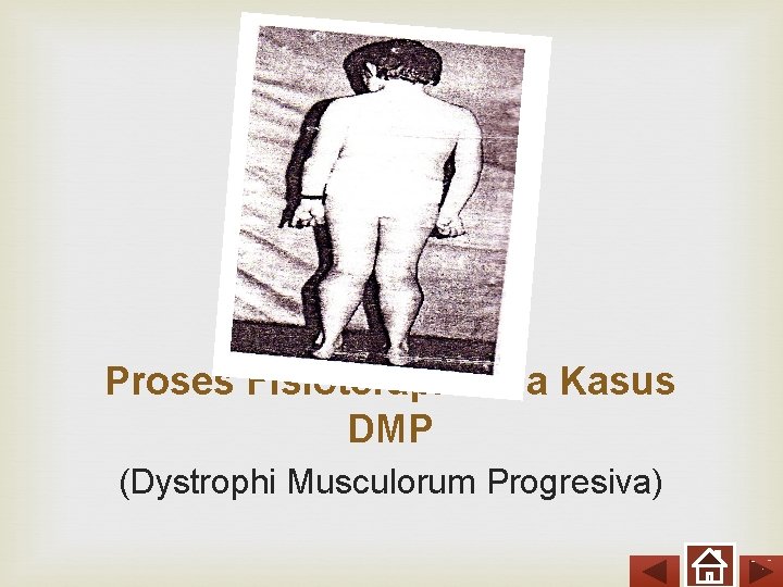 Proses Fisioterapi Pada Kasus DMP (Dystrophi Musculorum Progresiva) 