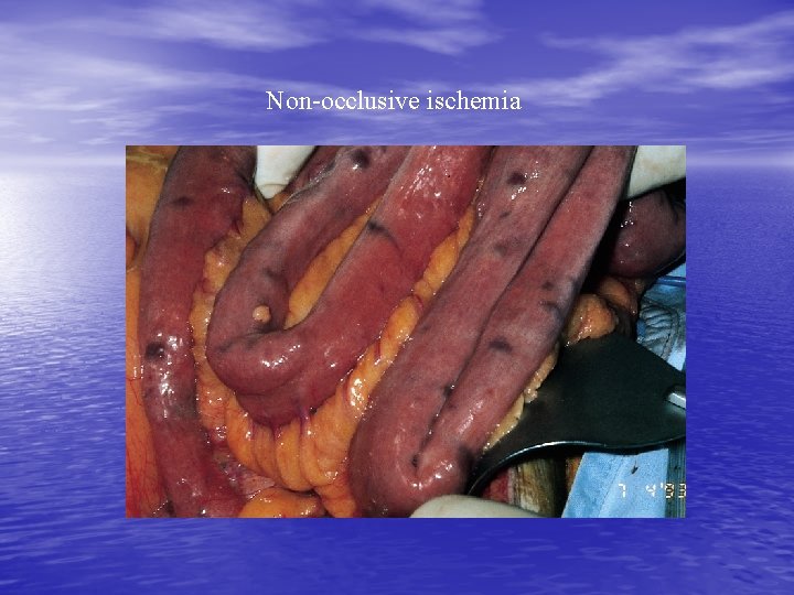 Non-occlusive ischemia 