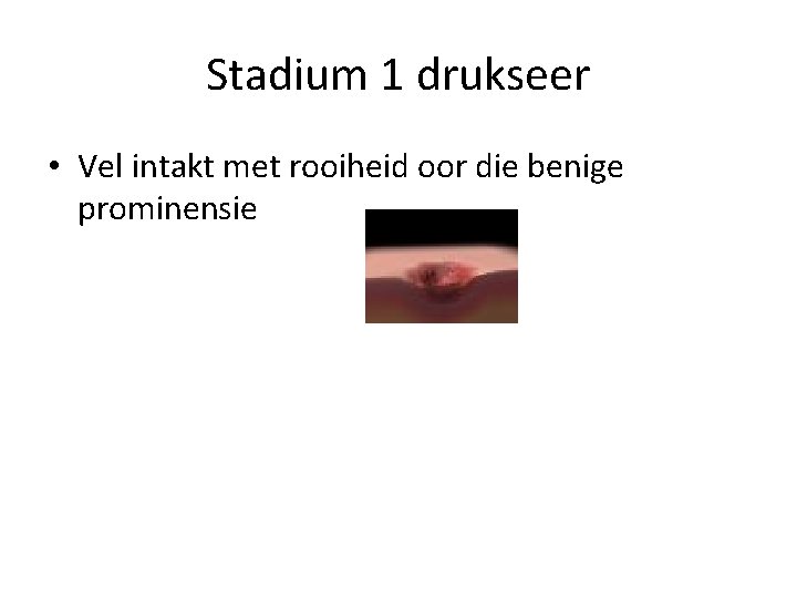 Stadium 1 drukseer • Vel intakt met rooiheid oor die benige prominensie 