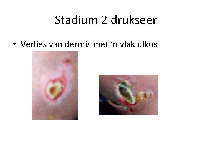 Stadium 2 drukseer • Verlies van dermis met ‘n vlak ulkus 