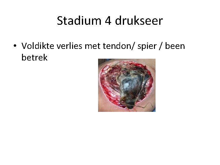 Stadium 4 drukseer • Voldikte verlies met tendon/ spier / been betrek 