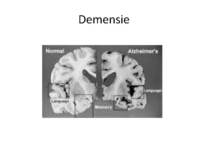 Demensie 