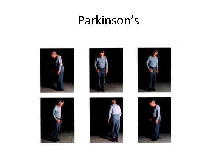 Parkinson’s 