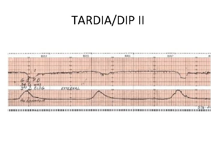 TARDIA/DIP II 