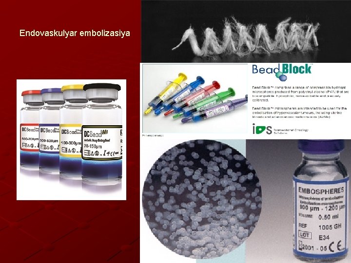 Endovaskulyar embolizasiya 